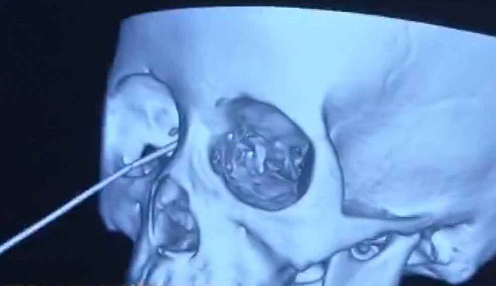 Gardening Pencil pierces woman’s eye socket, narrowly misses her brain in scary injury: report