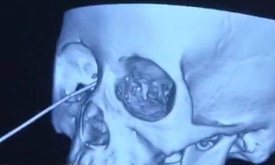 Gardening Pencil pierces woman’s eye socket, narrowly misses her brain in scary injury: report